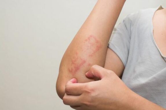 The latest ways to treat psoriasis