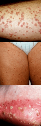 Psoriasis on the legs
