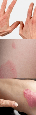 The initial stage of psoriasis