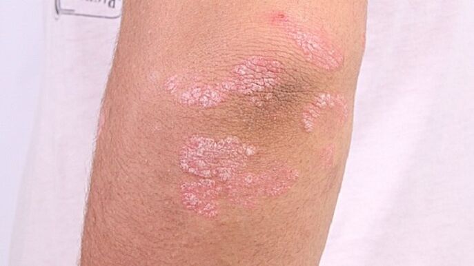 Early photos of psoriasis