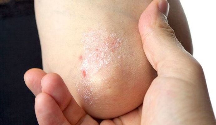 Early symptoms of psoriasis
