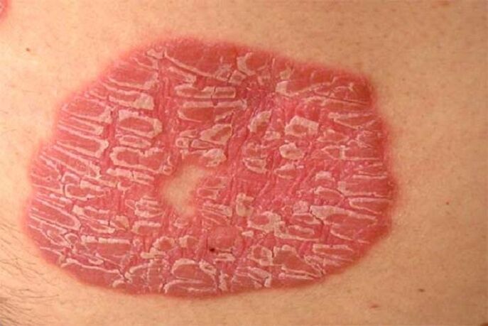Pustular psoriasis