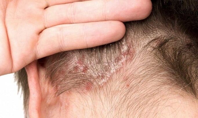 psoriasis on head