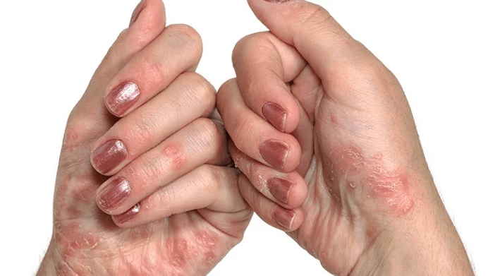 Early stage of psoriasis