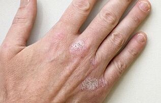 Early symptoms of psoriasis