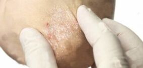 Psoriasis in the decay phase