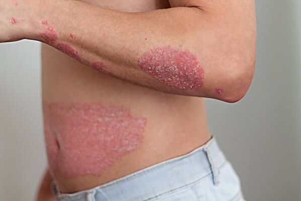 Psoriasis in a person