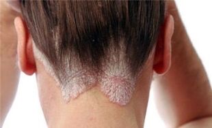 The development form and stage of psoriasis