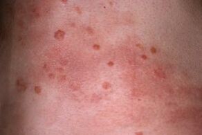 Photo of psoriasis on the skin