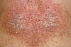 The onset of psoriasis