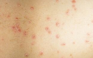 Early photos of psoriasis