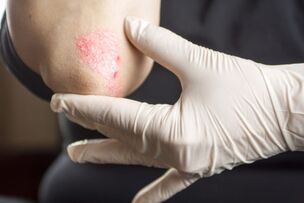 Principles of treatment of psoriasis