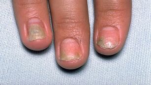 Causes of psoriasis on nails