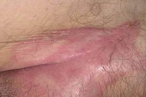 Early stage of psoriasis